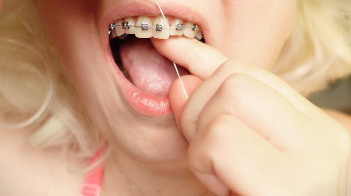 Braces!