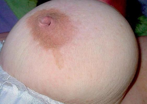 inverted nipple