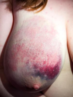 Mes seins meurtris après une dure séance de BDSM