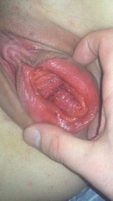 Prolaps vagina