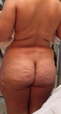 cellulite