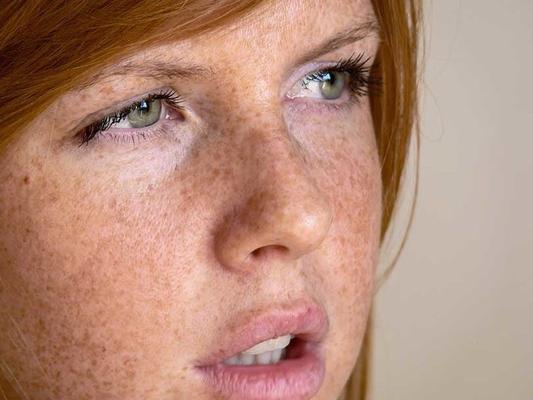 Freckles