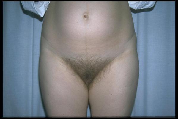6P Full bush pregnant 5