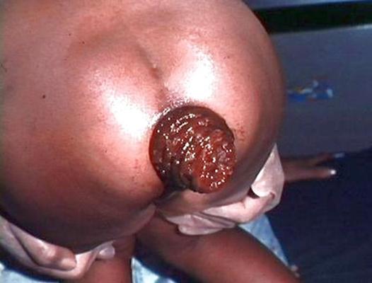 6P Prolapsus anaux non pornographiques