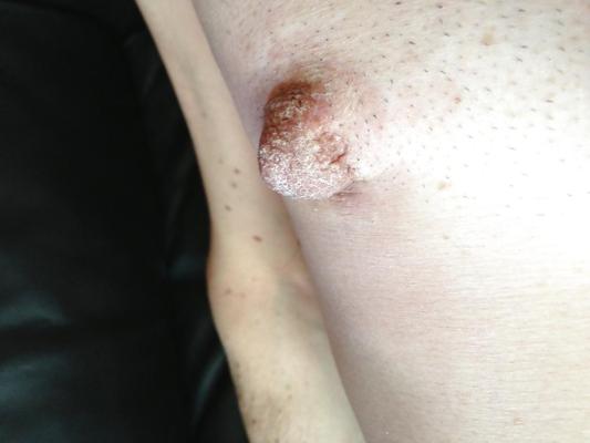19P NIPPLES STRETCHING