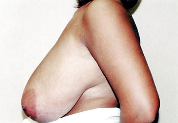 25P Big Natural And Saggy Tits Pre-OP Pictures