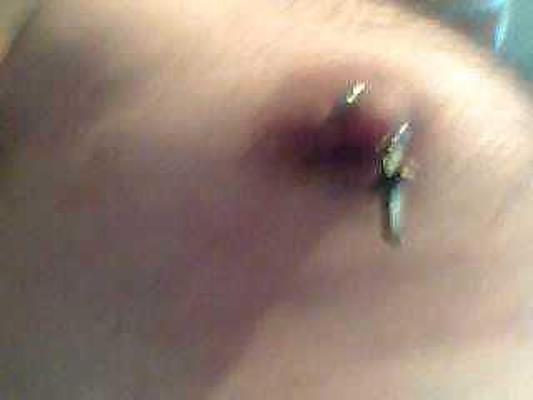 5P Nipple pain