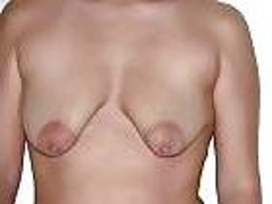 14P Saggy tits