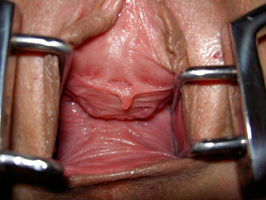 25P Speculum