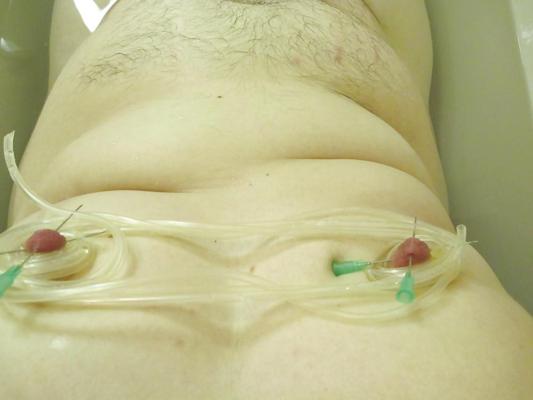 12P Pierced balls with 2 liters of saline