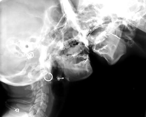 19P MRI または X 線の下でのセックス