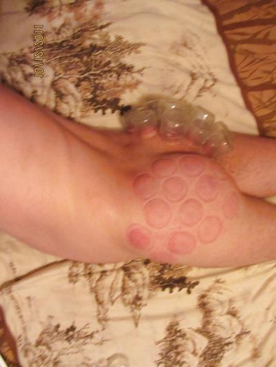11P Vacuum (fire cupping) ass torture