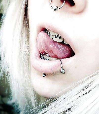 25P Teens With Braces 4