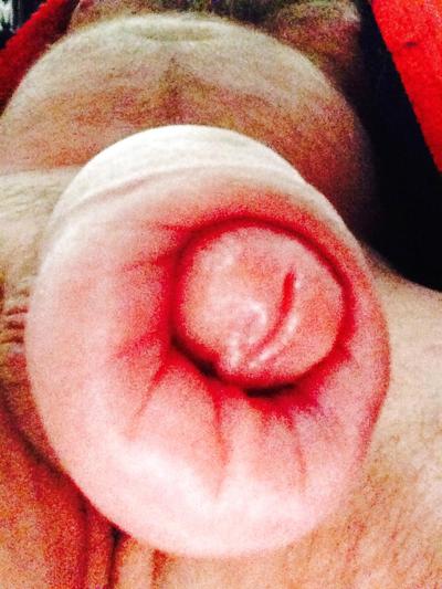 14P Huge swollen foreskin brutal pump severe bruising 