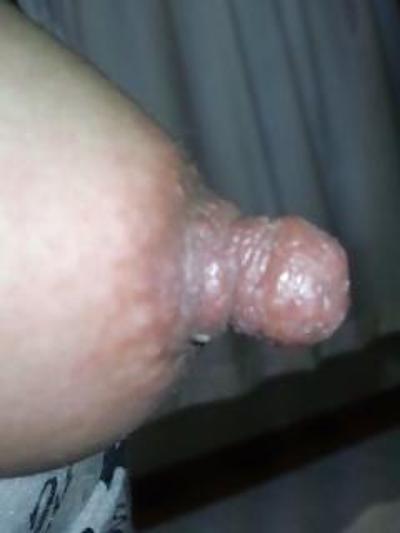 8P Nipples swollen with mosquito bites