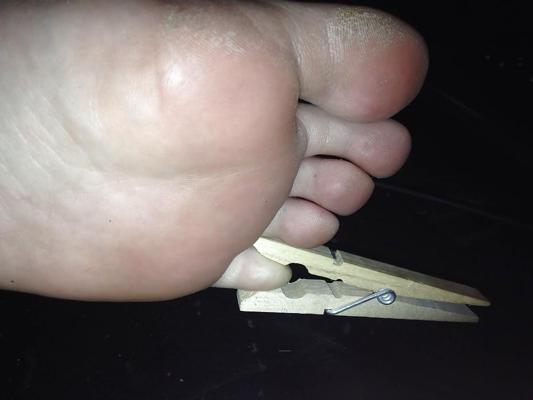 6P Toe or foot pain