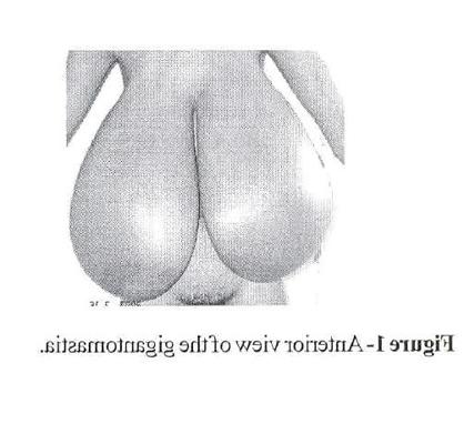 20P Macromastia Extrême Seins Noirs 9
