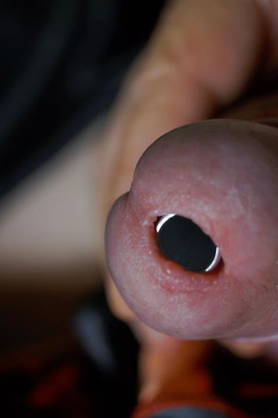 11P CBT insertion 