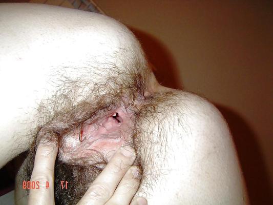 5P Hairy hole