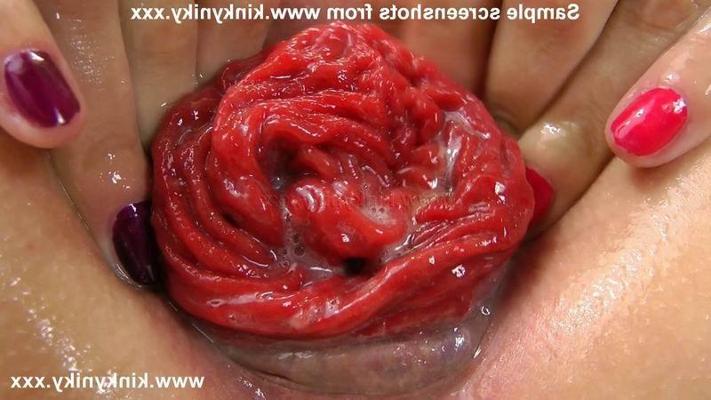 16P extreme anal fisting and anal prolapse