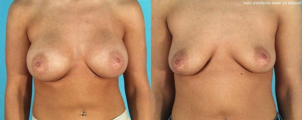 16P boobs and nipples