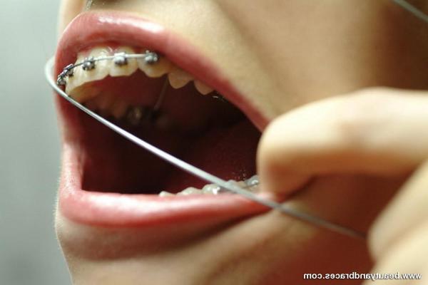 16P Nude blonde teen with braces has her head wrapped in wire