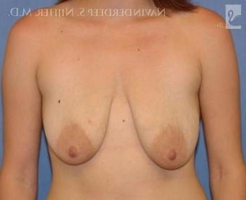25P Saggy breast vol 27